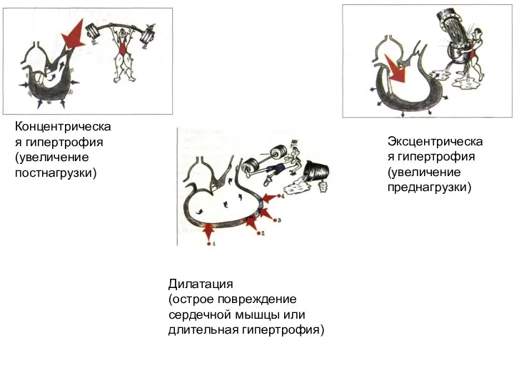 Концентрическая гипертрофия (увеличение постнагрузки) Эксцентрическая гипертрофия (увеличение преднагрузки) Дилатация (острое повреждение сердечной мышцы или длительная гипертрофия)