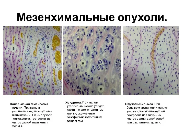 Мезенхимальные опухоли. Опухоль Вильмса. При большом увеличении можно увидеть, что