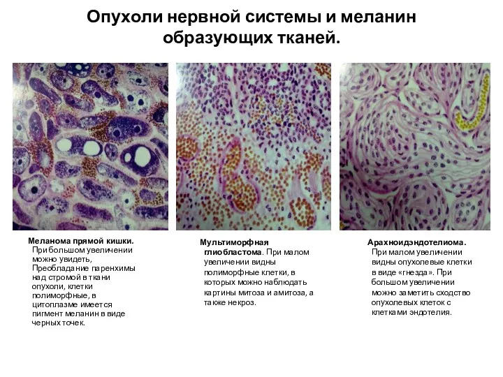 Опухоли нервной системы и меланин образующих тканей. Мультиморфная глиобластома. При малом увеличении видны
