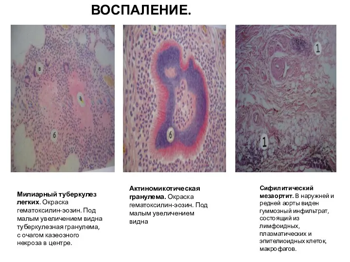 ПРОДУКТИВНОЕ ВОСПАЛЕНИЕ. Сифилитический мезаортит. В наружней и редней аорты виден