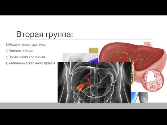 Вторая группа: 1)Механическая желтуха. 2)Гепатомегалия. 3)Проявления холангита. 4)Увеличение желчного пузыря.