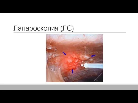 Лапароскопия (ЛС)