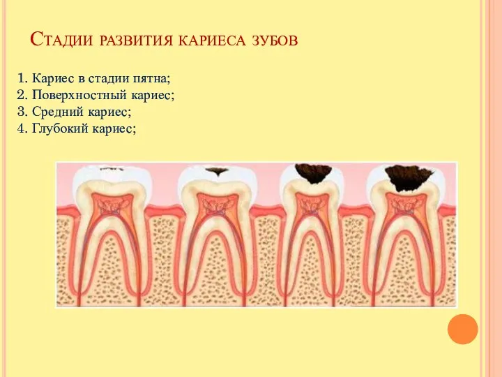 Стадии развития кариеса зубов 1. Кариес в стадии пятна; 2.