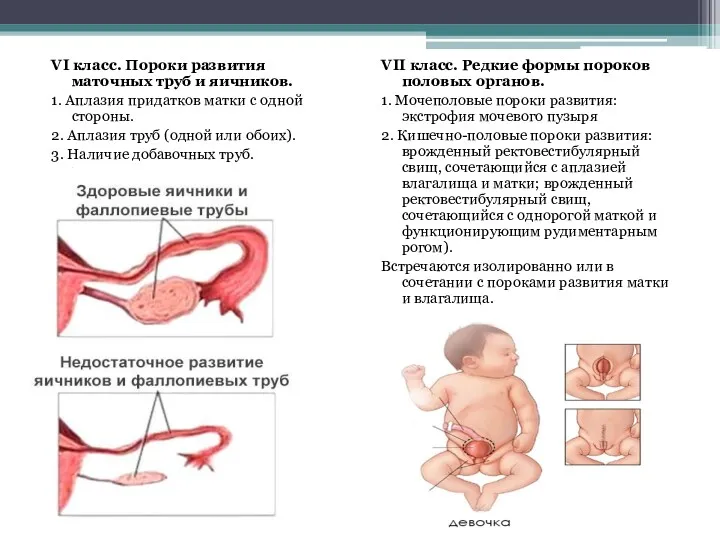 VI класс. Пороки развития маточных труб и яичников. 1. Аплазия придатков матки с
