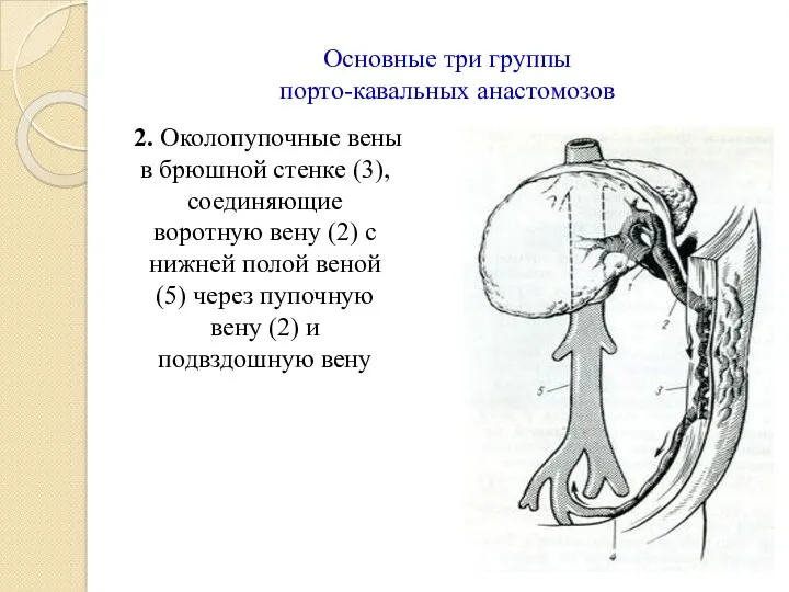 Основные три группы порто-кавальных анастомозов 2. Околопупочные вены в брюшной стенке (3), соединяющие