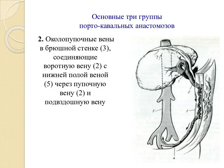 Основные три группы порто-кавальных анастомозов 2. Околопупочные вены в брюшной