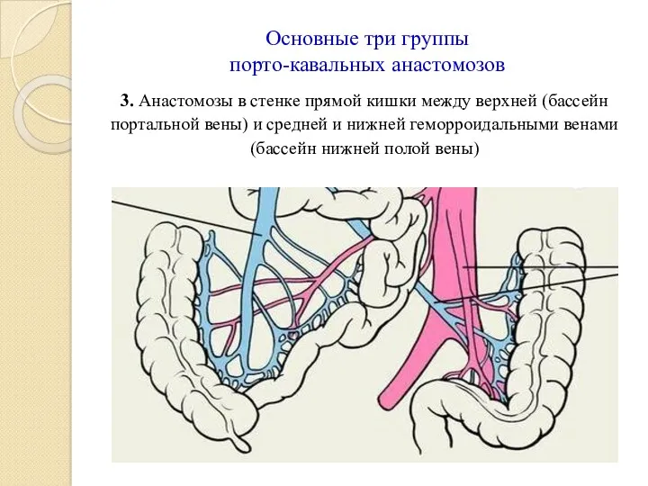 Основные три группы порто-кавальных анастомозов 3. Анастомозы в стенке прямой кишки между верхней
