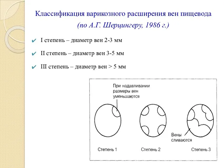 Классификация варикозного расширения вен пищевода (по А.Г. Шерцингеру, 1986 г.)