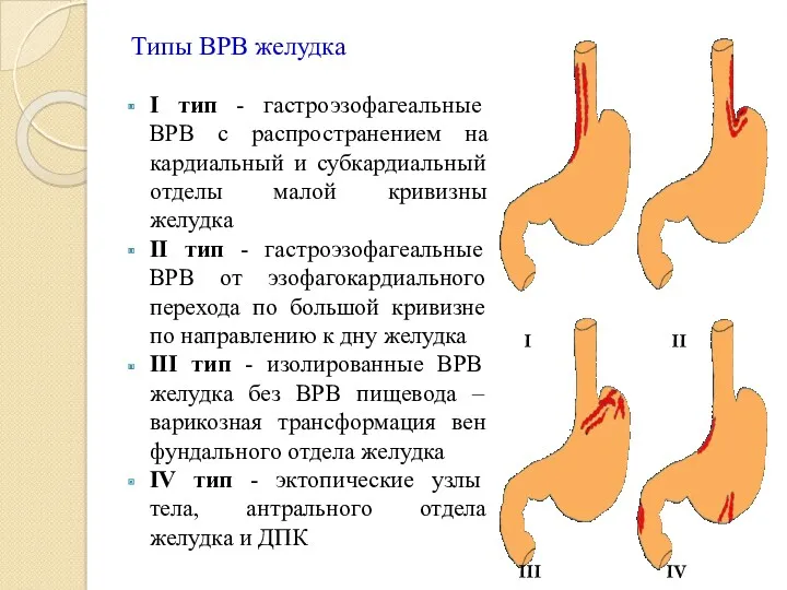 Типы ВРВ желудка I тип - гастроэзофагеальные ВРВ с распространением на кардиальный и