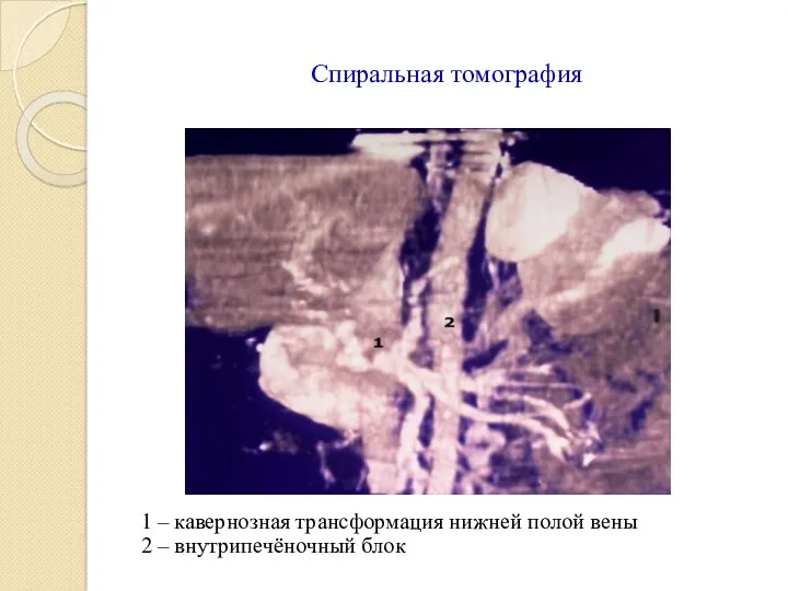 Спиральная томография 1 – кавернозная трансформация нижней полой вены 2 – внутрипечёночный блок