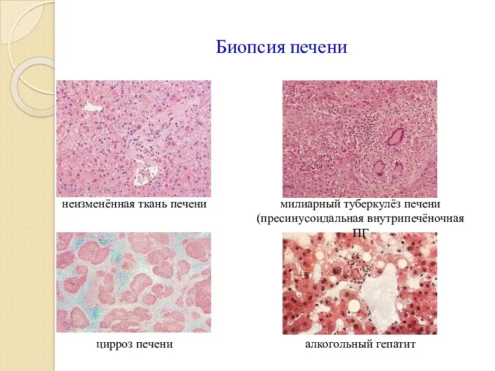 Биопсия печени неизменённая ткань печени милиарный туберкулёз печени (пресинусоидальная внутрипечёночная ПГ цирроз печени алкогольный гепатит