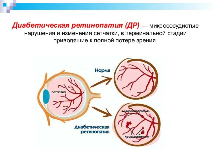 Диабетическая ретинопатия (ДР) — микрососудистые нарушения и изменения сетчатки, в терминальной стадии приводящие