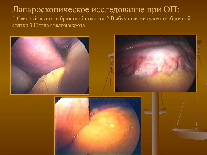 Лапароскопическое исследование при ОП: 1.Светлый выпот в брюшной полости 2.Выбухание желудочно-обдочной связки 3.Пятна стеатонекроза