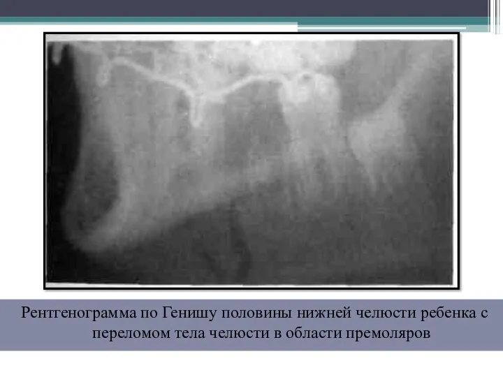 Рентгенограмма по Генишу половины нижней челюсти ребенка с переломом тела челюсти в области премоляров
