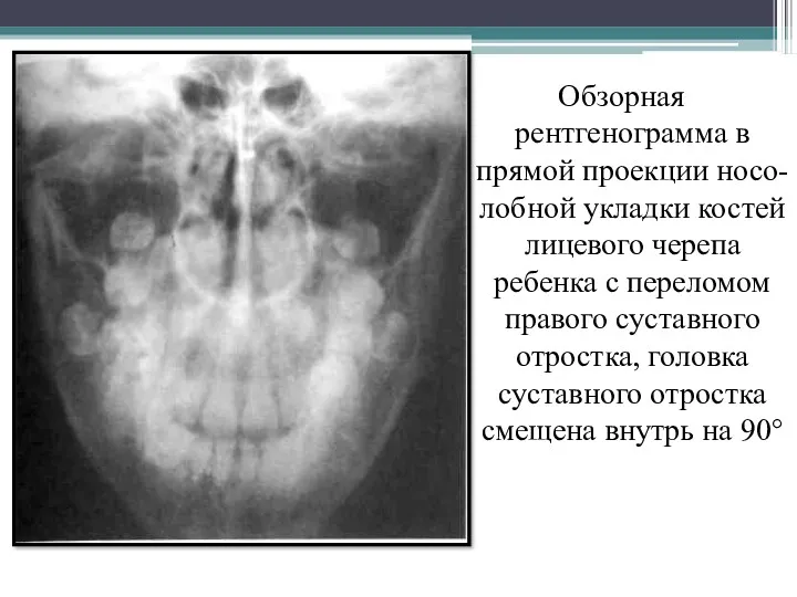 Обзорная рентгенограмма в прямой проекции носо-лобной укладки костей лицевого черепа ребенка с переломом