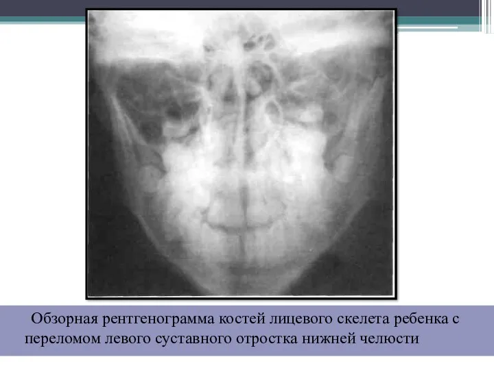 Обзорная рентгенограмма костей лицевого скелета ребенка с переломом левого суставного отростка нижней челюсти