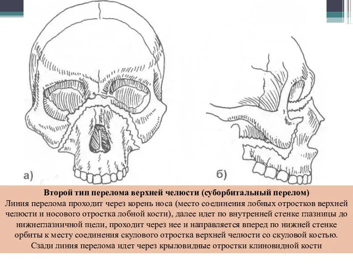 Второй тип перелома верхней челюсти (суборбитальный перелом) Линия перелома проходит через корень носа