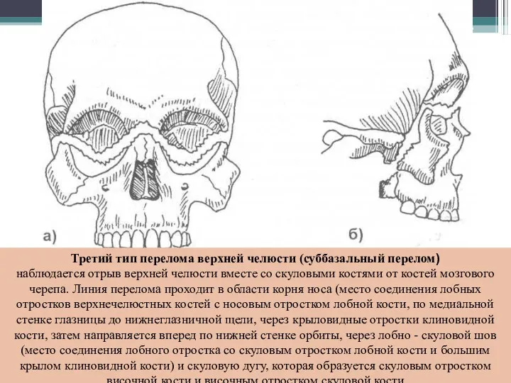 Третий тип перелома верхней челюсти (суббазальный перелом) наблюдается отрыв верхней челюсти вместе со