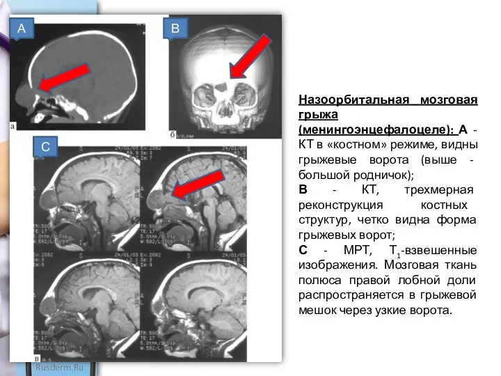 В А С Назоорбитальная мозговая грыжа (менингоэнцефалоцеле): А - КТ
