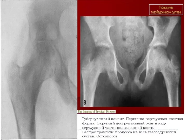 Туберкулезный коксит. Первично-вертлужная костная форма. Округлый деструктивный очаг в над-вертлужной