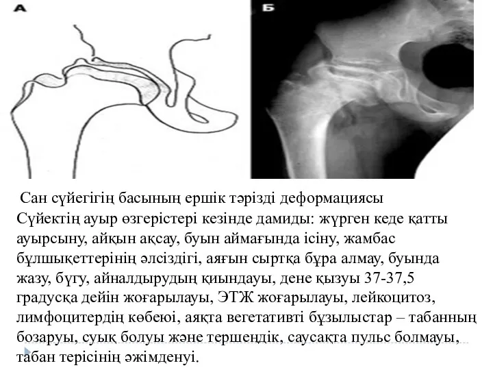 Сүйектің ауыр өзгерістері кезінде дамиды: жүрген кеде қатты ауырсыну, айқын