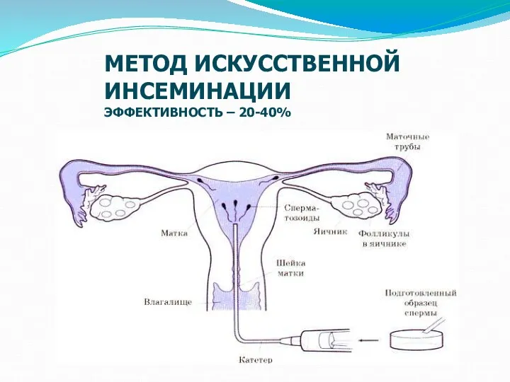 МЕТОД ИСКУССТВЕННОЙ ИНСЕМИНАЦИИ ЭФФЕКТИВНОСТЬ – 20-40%