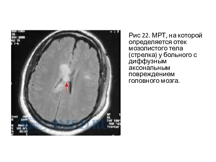 Рис 22. МРТ, на которой определяется отек мозолистого тела (стрелка)