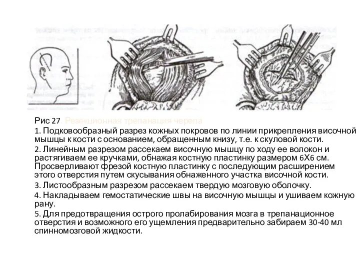 Рис 27. Резекционная трепанация черепа 1. Подковообразный разрез кожных покровов