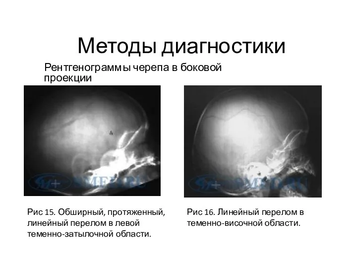 Методы диагностики Рентгенограммы черепа в боковой проекции Рис 15. Обширный,