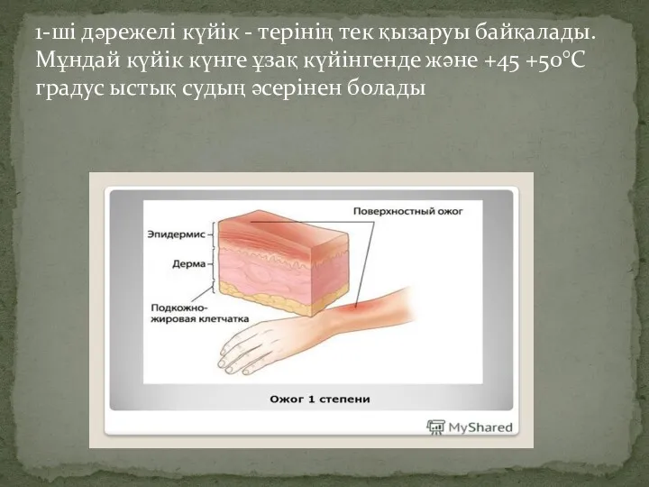 1-ші дәрежелі күйік - терінің тек қызаруы байқалады. Мұндай күйік күнге ұзақ күйінгенде