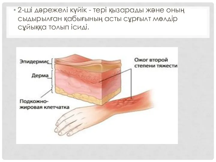 2-ші дәрежелі күйік - тері қызарады және оның сыдырылған қабығының асты сұрғылт мөлдір сұйыққа толып ісиді.