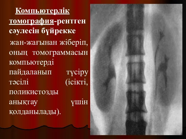 Компьютерлік томография-рентген сәулесін бүйрекке жан-жағынан жіберіп, оның томограммасын компьютерді пайдаланып