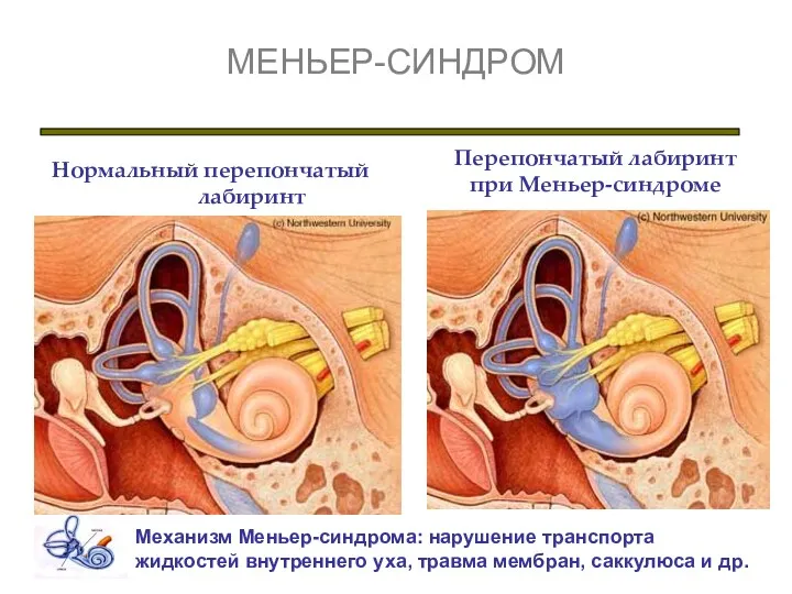 МЕНЬЕР-СИНДРОМ Нормальный перепончатый лабиринт Перепончатый лабиринт при Меньер-синдроме Механизм Меньер-синдрома: