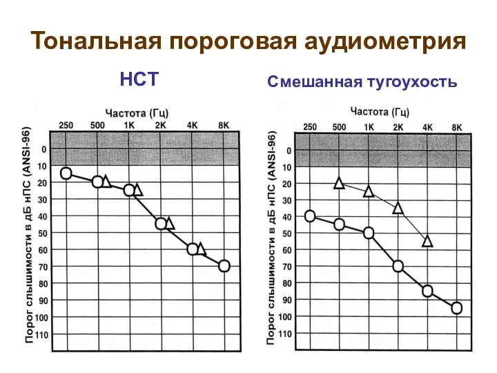 Тональная пороговая аудиометрия НСТ Смешанная тугоухость