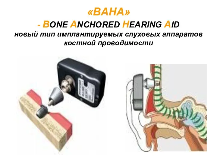 «BAHA» - ВОNЕ ANCHORED HEARING AID новый тип имплантируемых слуховых аппаратов костной проводимости