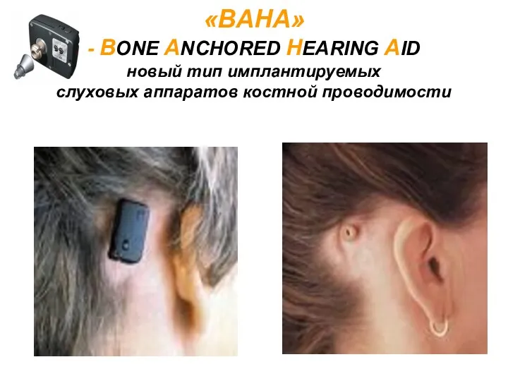 «BAHA» - ВОNЕ ANCHORED HEARING AID новый тип имплантируемых слуховых аппаратов костной проводимости