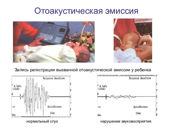 Отоакустическая эмиссия нормальный слух нарушение звуковосприятия Запись регистрации вызванной отоакустической эмиссии у ребенка