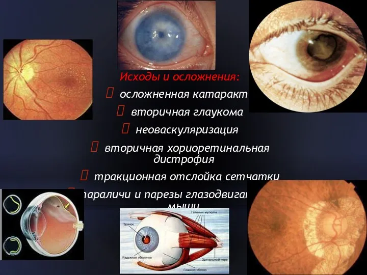 Исходы и осложнения: осложненная катаракта вторичная глаукома неоваскуляризация вторичная хориоретинальная