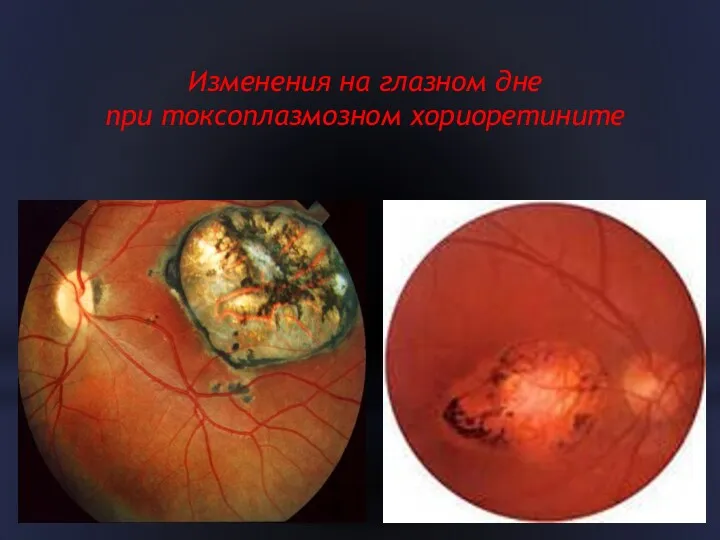 Изменения на глазном дне при токсоплазмозном хориоретините