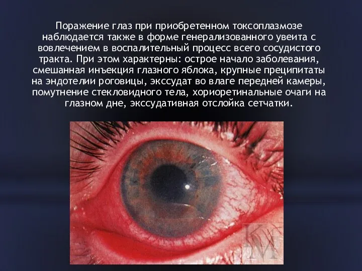 Поражение глаз при приобретенном токсоплазмозе наблюдается также в форме генерализованного увеита с вовлечением