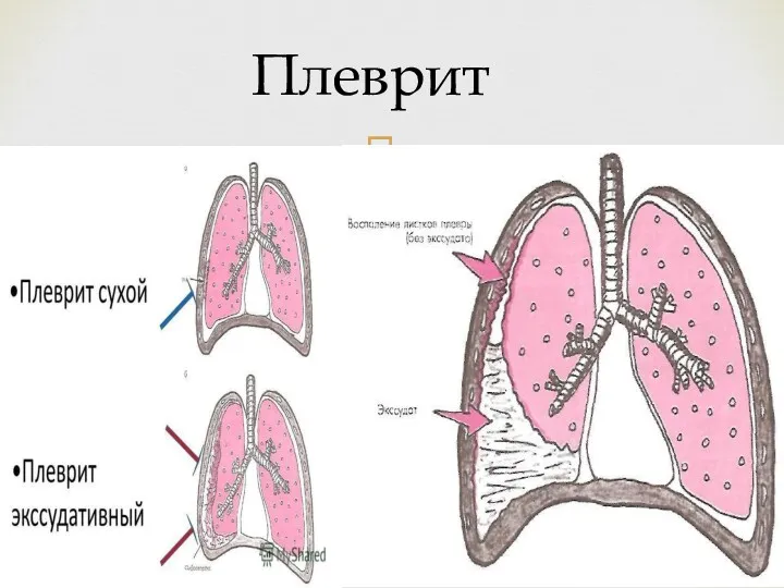 Плеврит