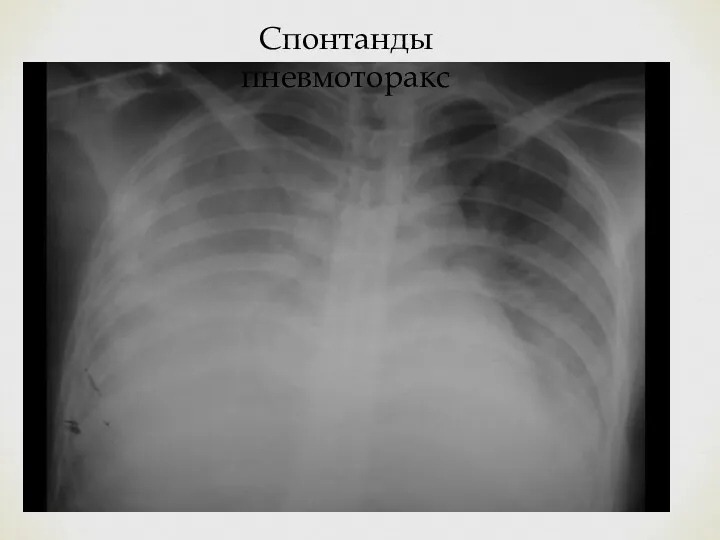 Спонтанды пневмоторакс