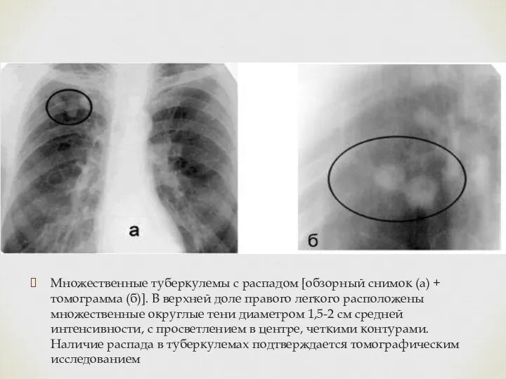 Множественные туберкулемы с распадом [обзорный снимок (а) + томограмма (б)].