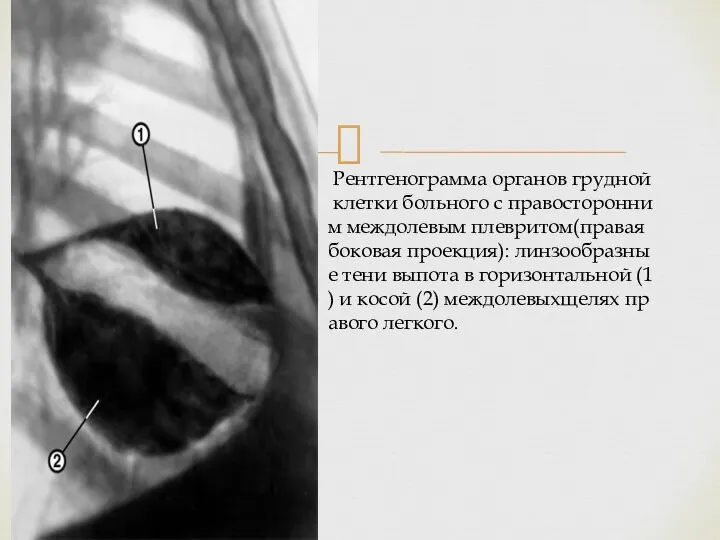 Рентгенограмма органов грудной клетки больного с правосторонним междолевым плевритом(правая боковая