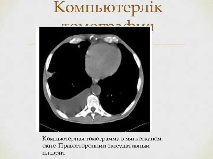 Компьютерлік томография Компьютерная томограмма в мягкотканом окне. Правосторонний экссудативный плеврит