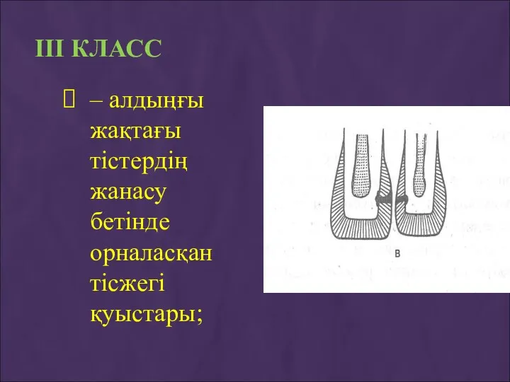 ІІІ КЛАСС – алдыңғы жақтағы тістердің жанасу бетінде орналасқан тісжегі қуыстары;