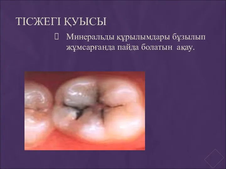 ТІСЖЕГІ ҚУЫСЫ Минеральды құрылымдары бұзылып жұмсарғанда пайда болатын ақау.