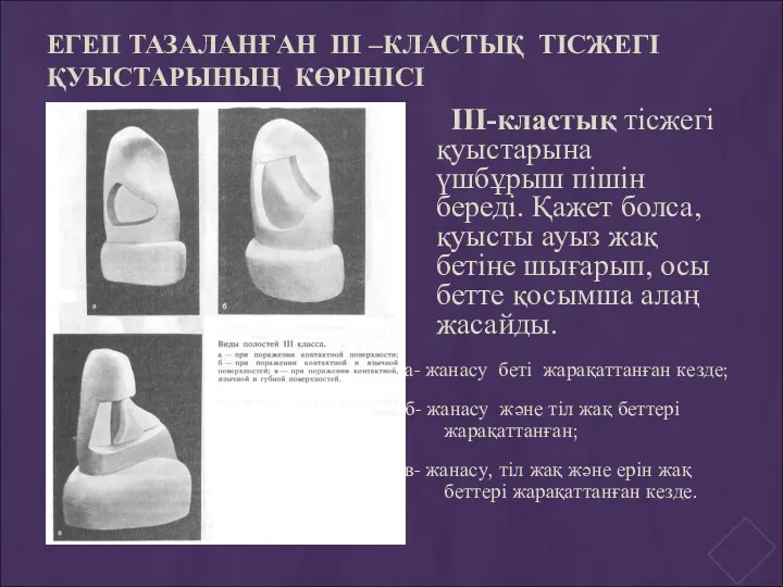 ЕГЕП ТАЗАЛАНҒАН ІІІ –КЛАСТЫҚ ТІСЖЕГІ ҚУЫСТАРЫНЫҢ КӨРІНІСІ а- жанасу беті