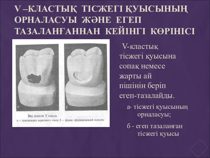 V –КЛАСТЫҚ ТІСЖЕГІ ҚУЫСЫНЫҢ ОРНАЛАСУЫ ЖӘНЕ ЕГЕП ТАЗАЛАНҒАННАН КЕЙІНГІ КӨРІНІСІ