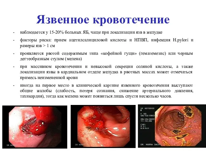 Язвенное кровотечение наблюдается у 15-20% больных ЯБ, чаще при локализации